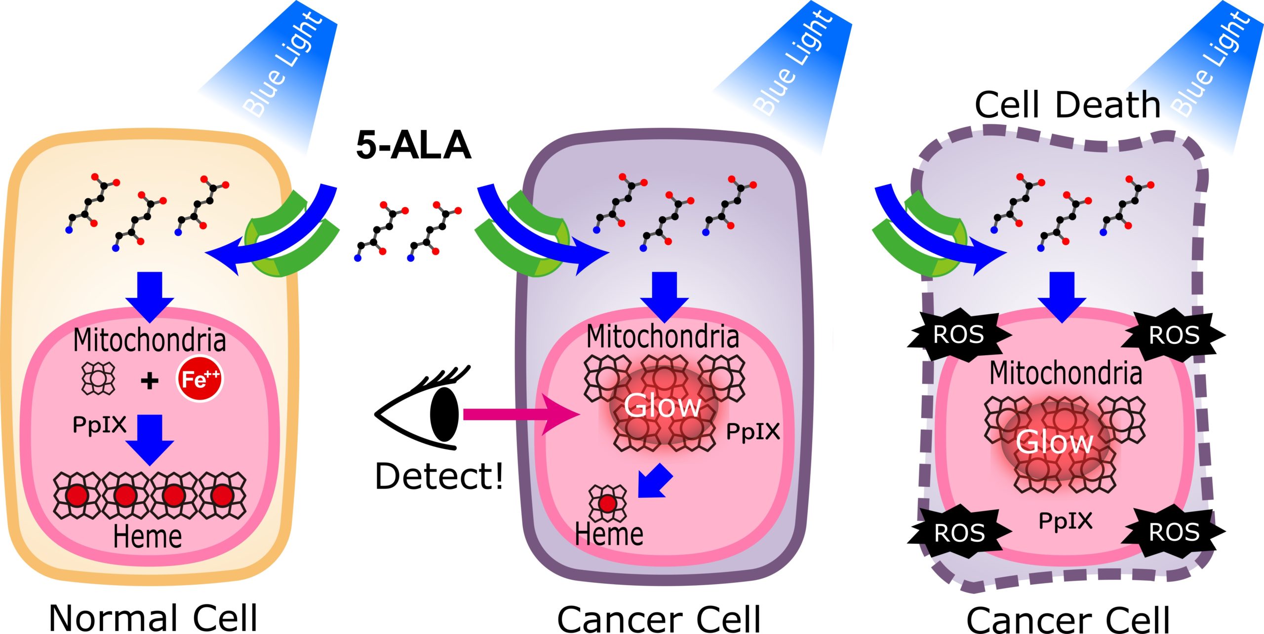 5-aminolevulinic acid cancer detection & treatment